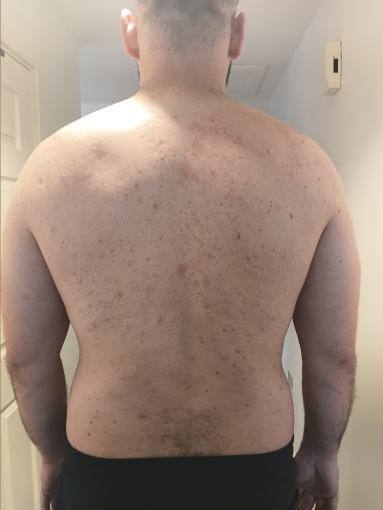 Revitalise Aesthetics Liverpool BioRePeel pigmentation skin clarity after Revitalise Aesthetics Liverpool BioRePeel pigmentation skin clarity after