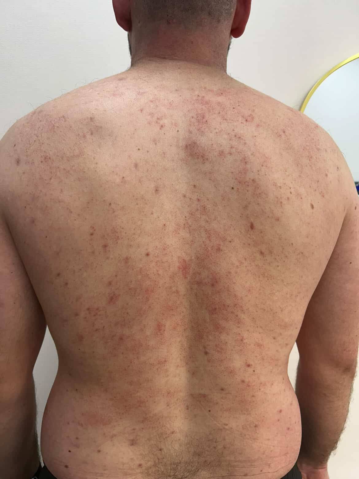 Revitalise Aesthetics Liverpool BioRePeel pigmentation skin clarity before Revitalise Aesthetics Liverpool BioRePeel pigmentation skin clarity before