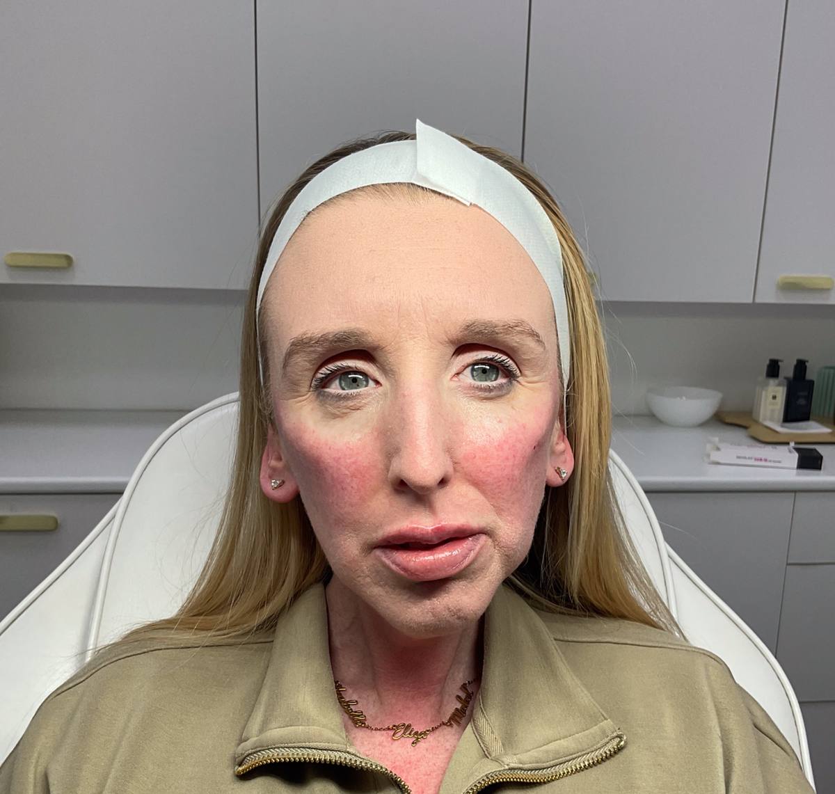 Dermal filler results at Revitalise Aesthetics Liverpool Dermal filler results at Revitalise Aesthetics Liverpool