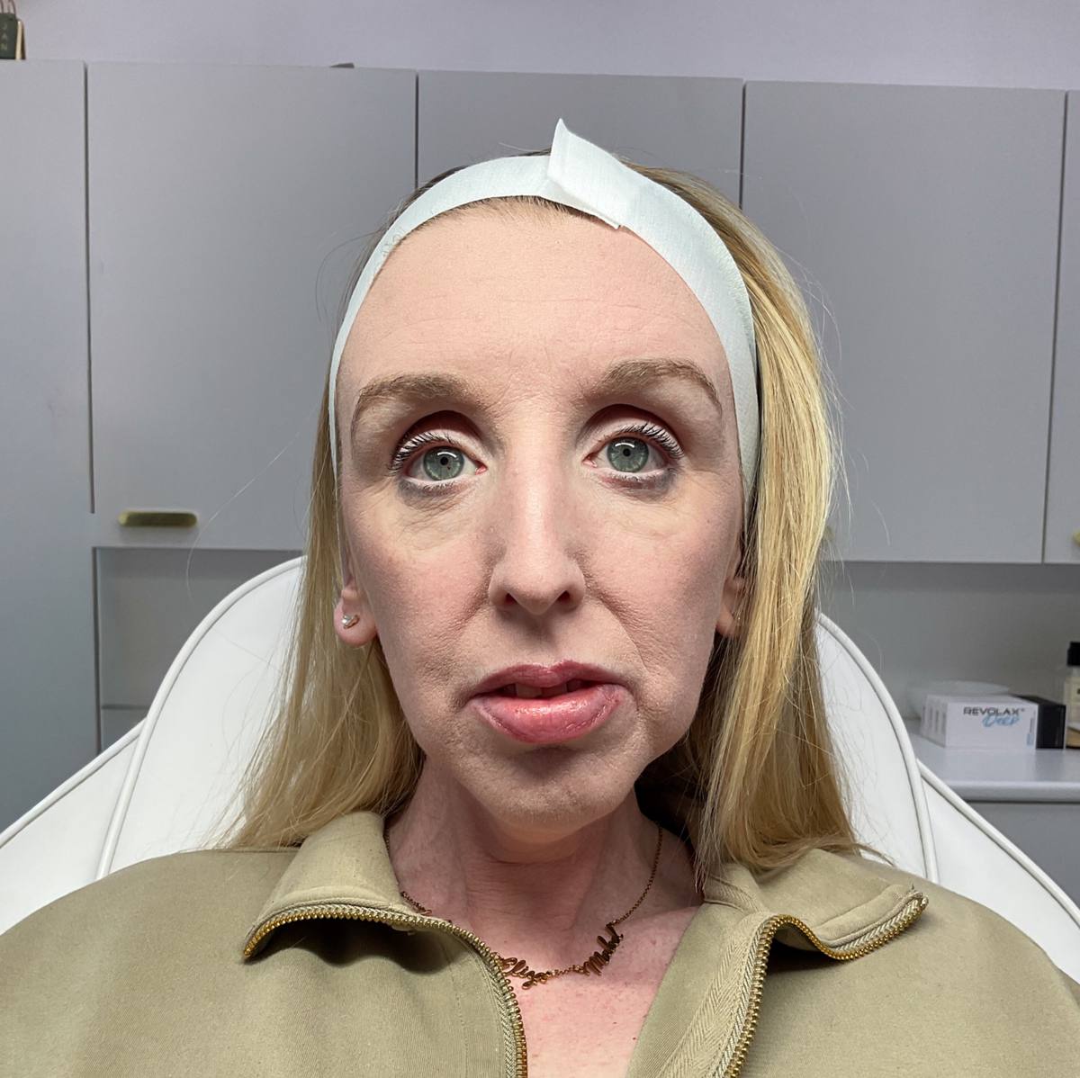 Dermal filler cheek profile balancing before at Revitalise Aesthetics Liverpool Dermal filler cheek profile balancing before at Revitalise Aesthetics Liverpool