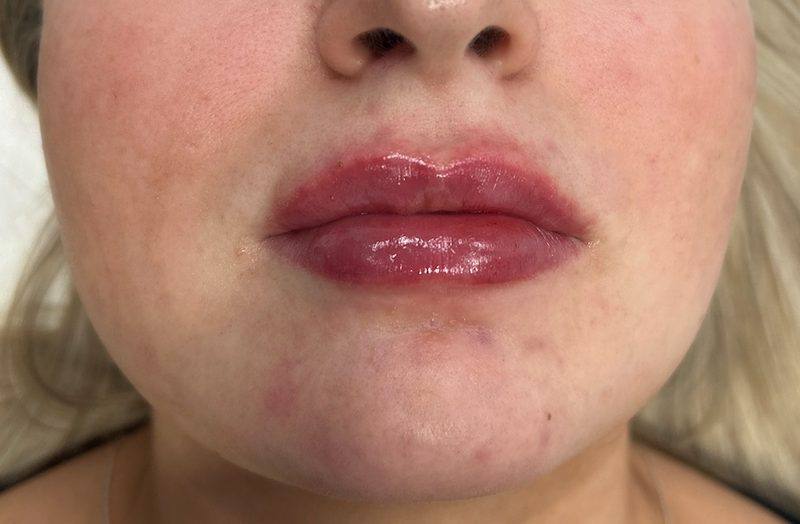 Revitalise Aesthetics Liverpool lip filler after Revitalise Aesthetics Liverpool lip filler after