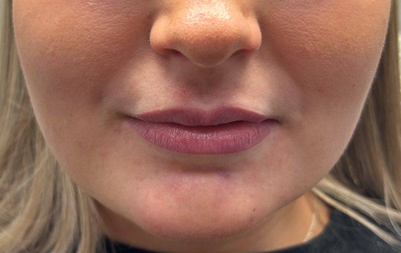 Revitalise Aesthetics Liverpool lip filler before Revitalise Aesthetics Liverpool lip filler before