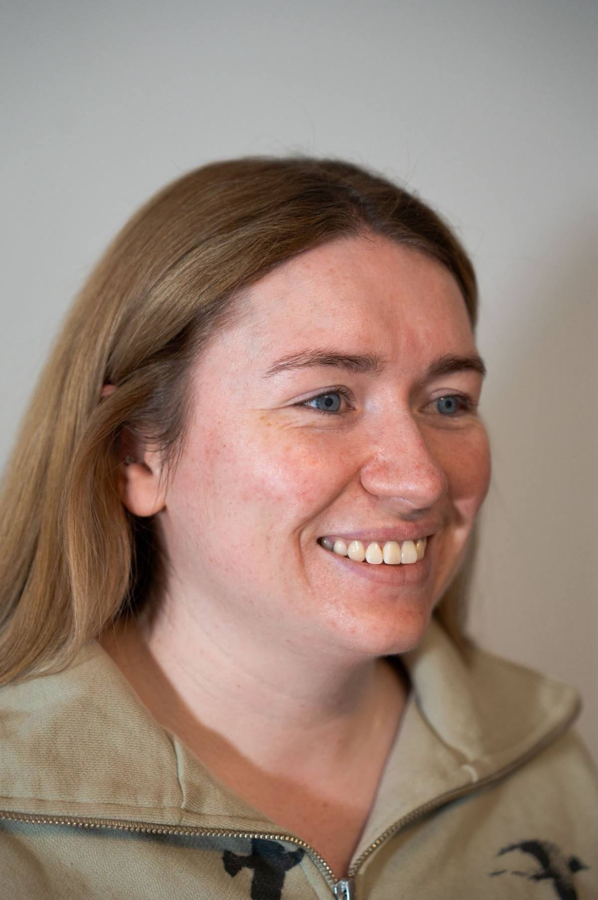 Revitalise Aesthetics Liverpool Polynucleotides acne skin texture after Revitalise Aesthetics Liverpool Polynucleotides acne skin texture after