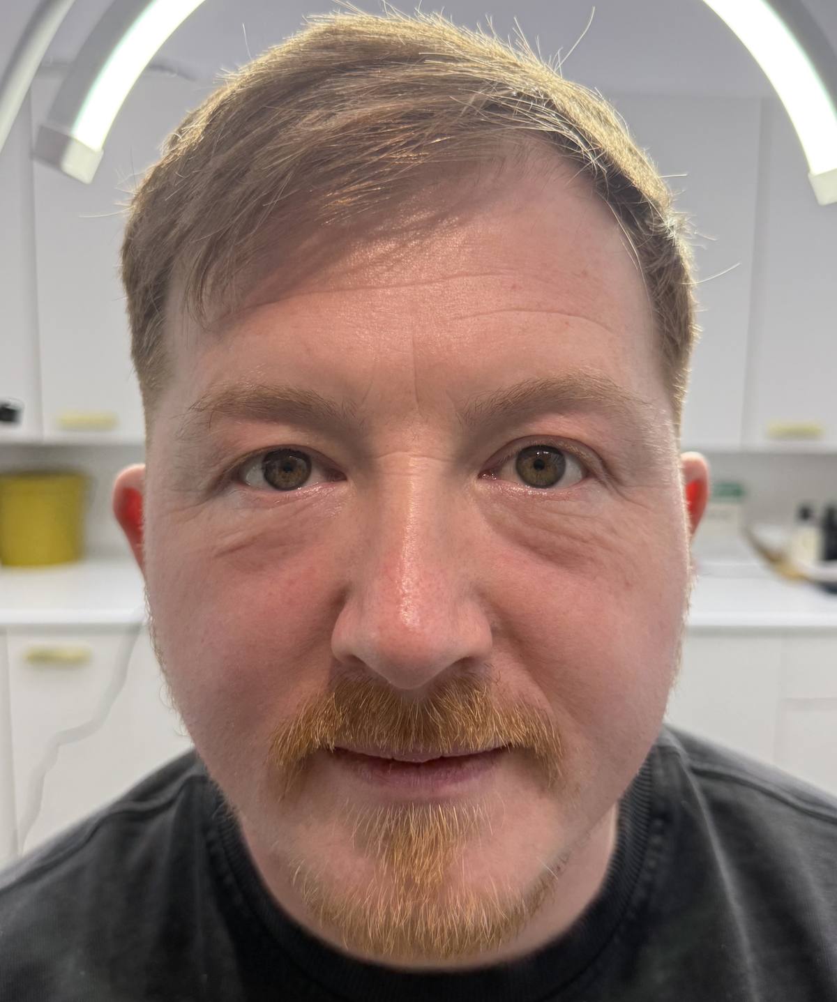 Revitalise Aesthetics Liverpool PRP under eye rejuvenation after Revitalise Aesthetics Liverpool PRP under eye rejuvenation after