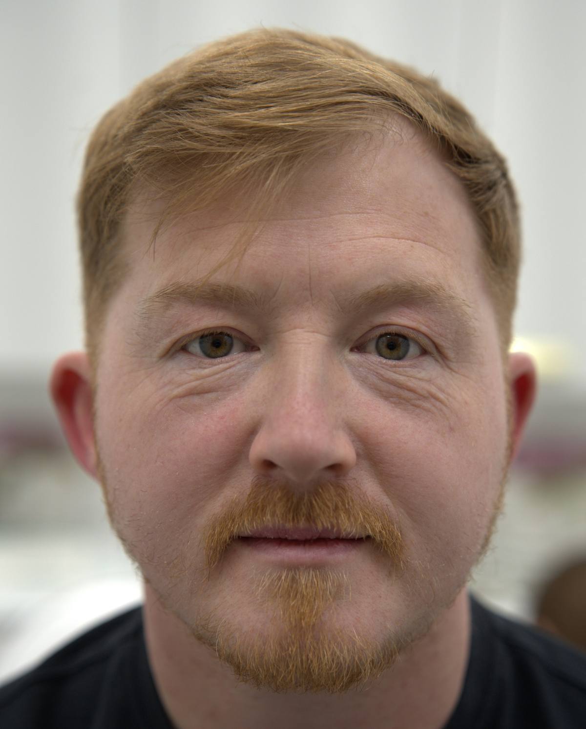 Revitalise Aesthetics Liverpool PRP under eye rejuvenation before Revitalise Aesthetics Liverpool PRP under eye rejuvenation before