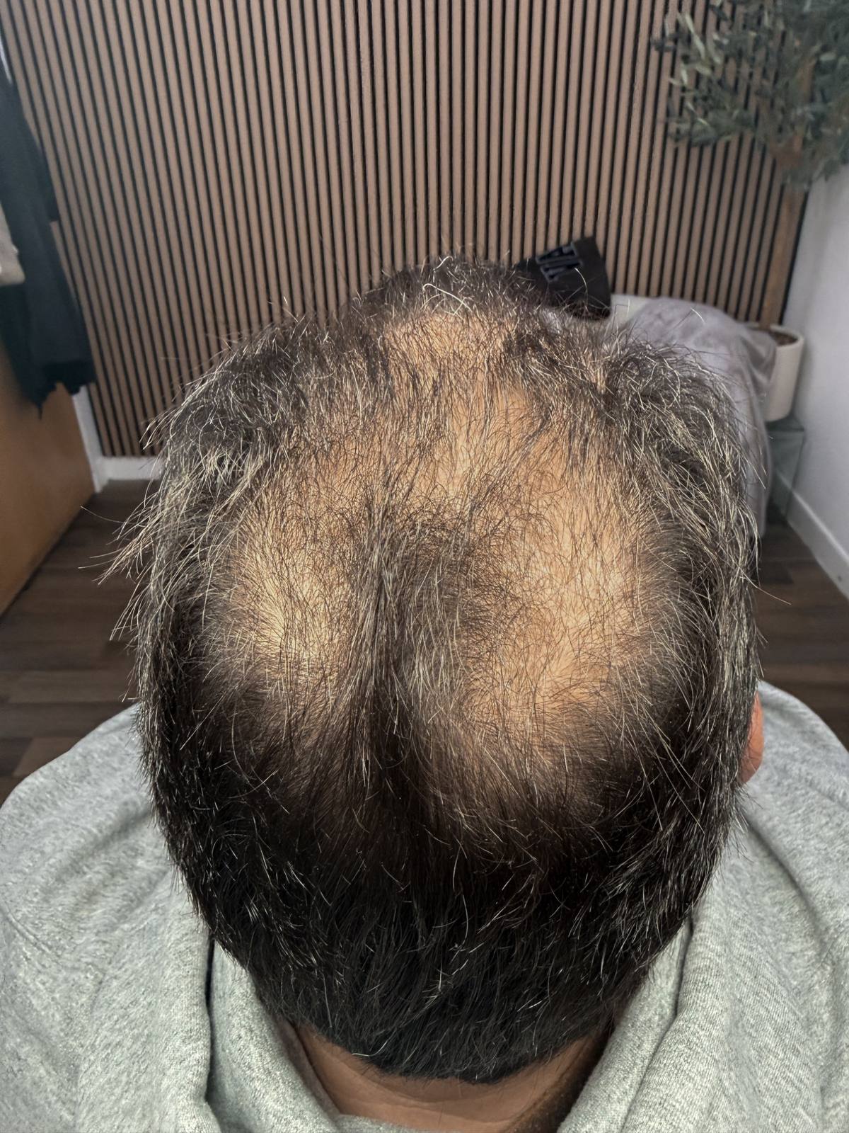 Revitalise Aesthetics Liverpool scalp microneedling hair restoration after Revitalise Aesthetics Liverpool scalp microneedling hair restoration after