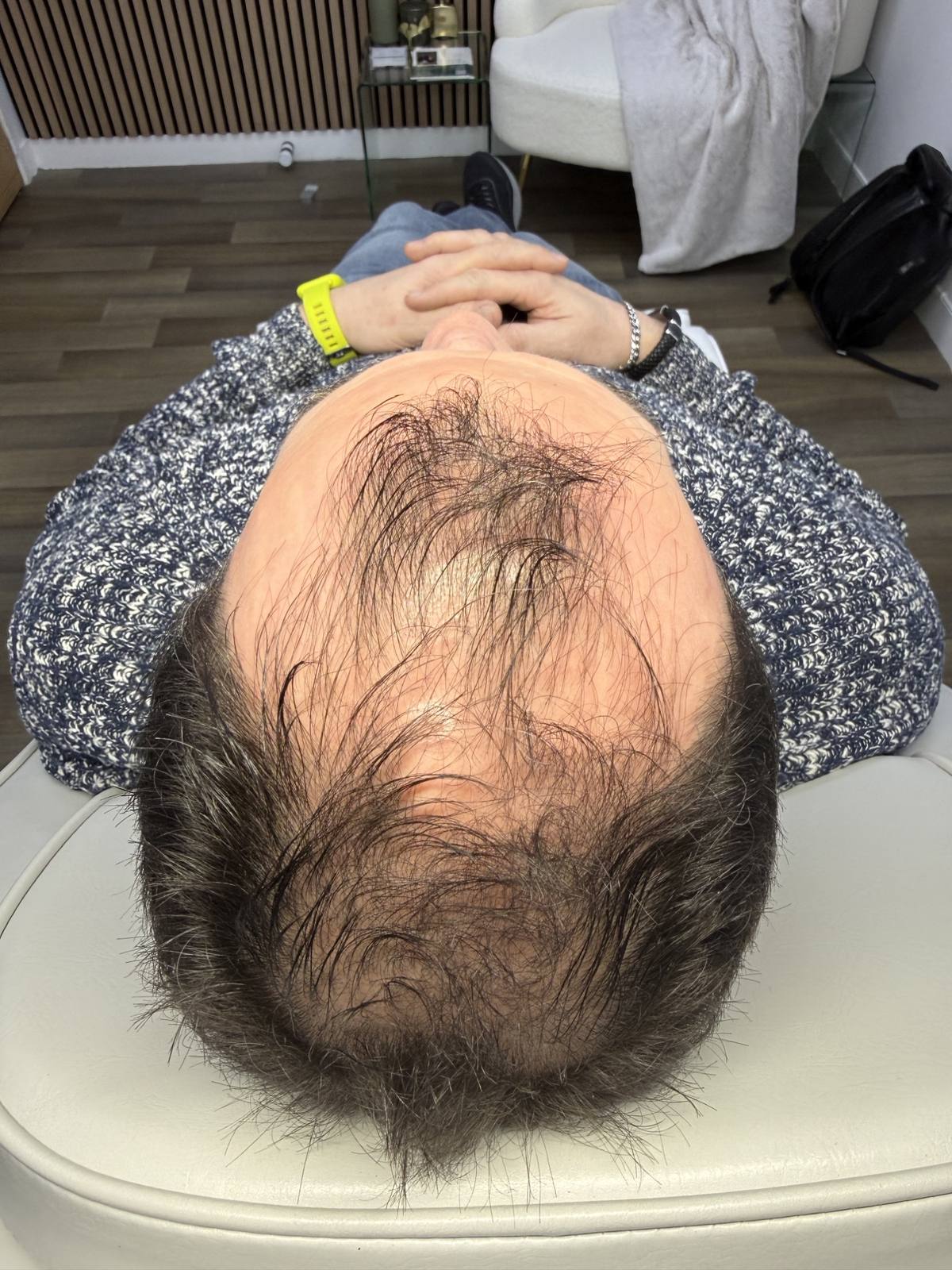 Revitalise Aesthetics Liverpool scalp microneedling hair restoration before Revitalise Aesthetics Liverpool scalp microneedling hair restoration before